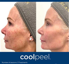 Load image into Gallery viewer, Ultimate Aesthetic Transformation — CoolPeel + Morpheus8 + ThermiTight