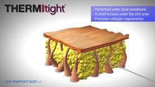 Load image into Gallery viewer, Body Contouring Package — Morpheus8 + ThermiTight Abdomen